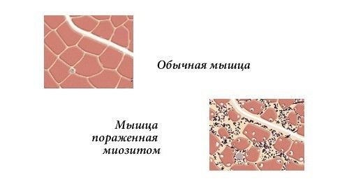 Болят мышцы спины груди