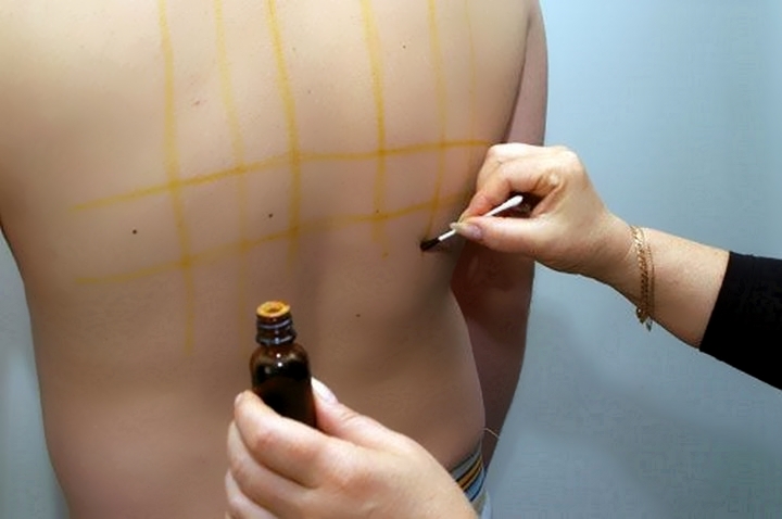 Нанесение йодной сетки Нанесение йодной сетки