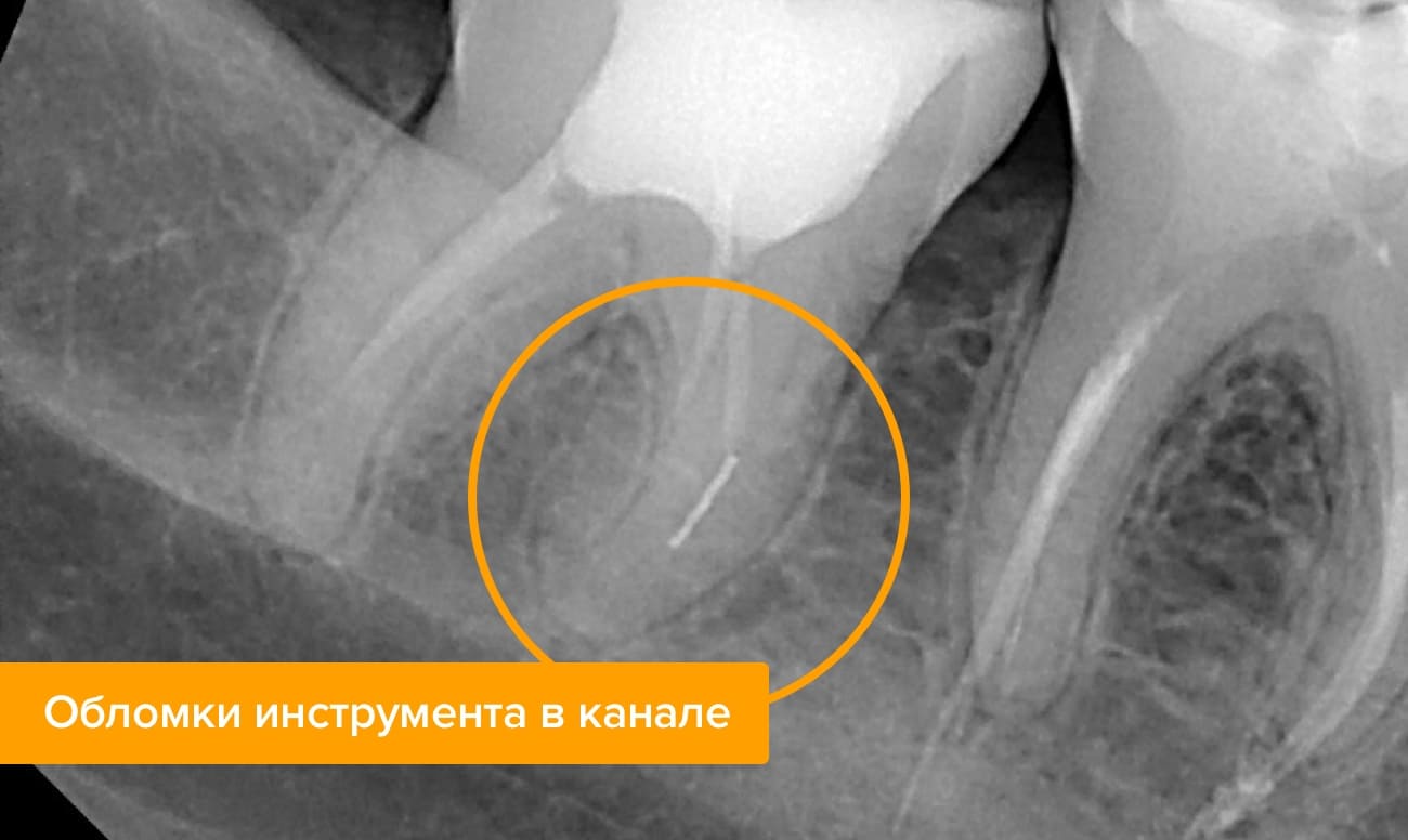 Обломки инструмента в канале Обломки инструмента в канале на рентгене