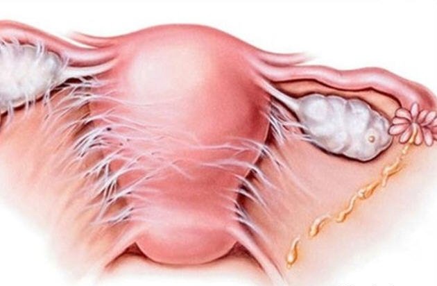 Параметрит