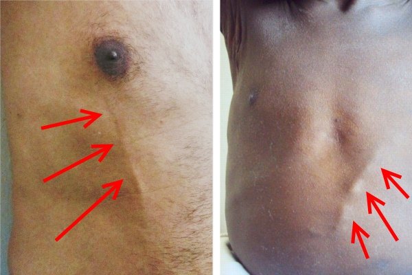 Болят мышцы спины груди