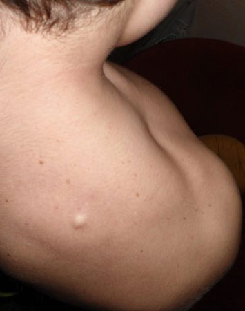 Опухоль на спине не болит не чешется
