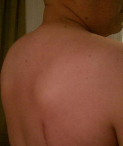 Шишка на спине Возможные причины возникновения шишки на спине