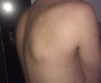 Шишка на спине около позвоночника