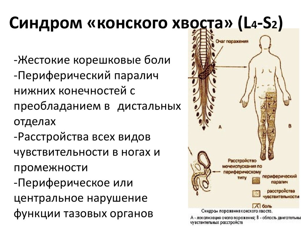 Синдром конского хвоста