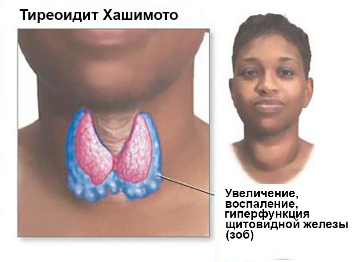 Аутоиммунный тиреоидит (тиреоидит Хашимото) Аутоиммунный тиреоидит (тиреоидит Хашимото)