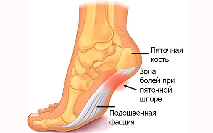 Боль при пяточной шпоре Боль при пяточной шпоре