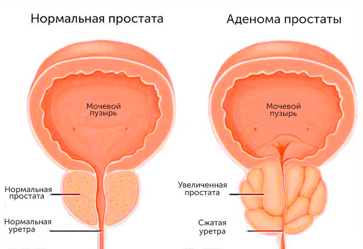 Что такое аденома простаты Что такое аденома простаты
