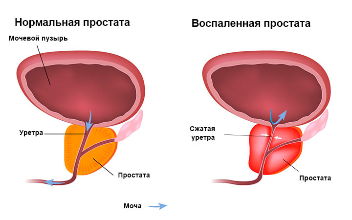 Что такое простатит Что такое простатит