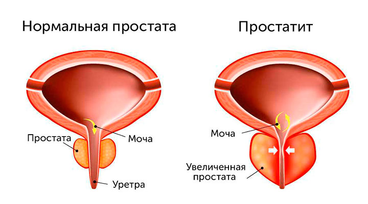 Воспаленная предстательная железа Воспаленная предстательная железа