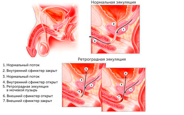 Что такое ретроградная эякуляция Что такое ретроградная эякуляция