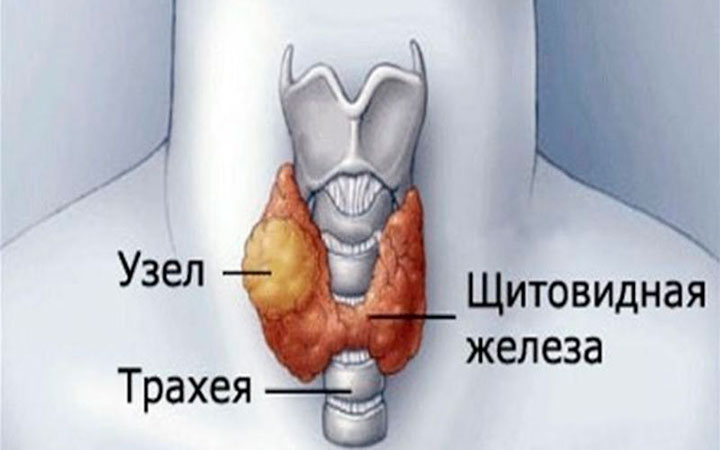 Узел щитовидной железы Узел щитовидной железы