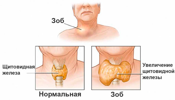 Зоб щитовидной железы Зоб щитовидной железы