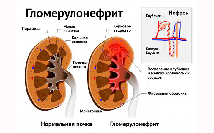 Гломерулонефрит Гломерулонефрит