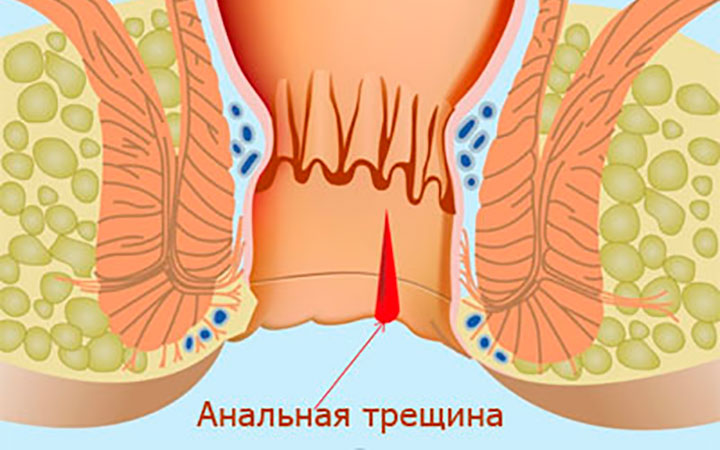 Анальная трещина Анальная трещина