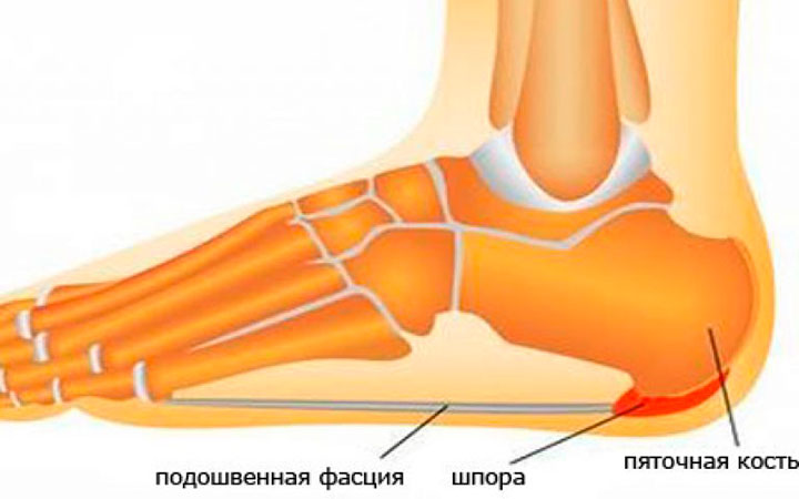 Плантарный фасциит Плантарный фасциит