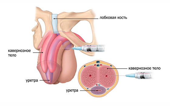 Как правильно сделать укол в половой член Как правильно сделать укол в половой член
