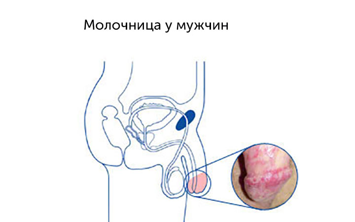 Молочница у мужчин Молочница у мужчин