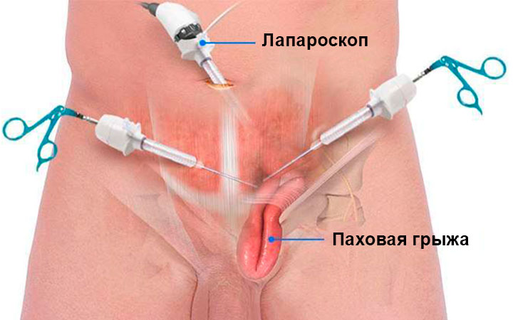 Лапароскопическая операция паховой грыжи Лапароскопическая операция паховой грыжи