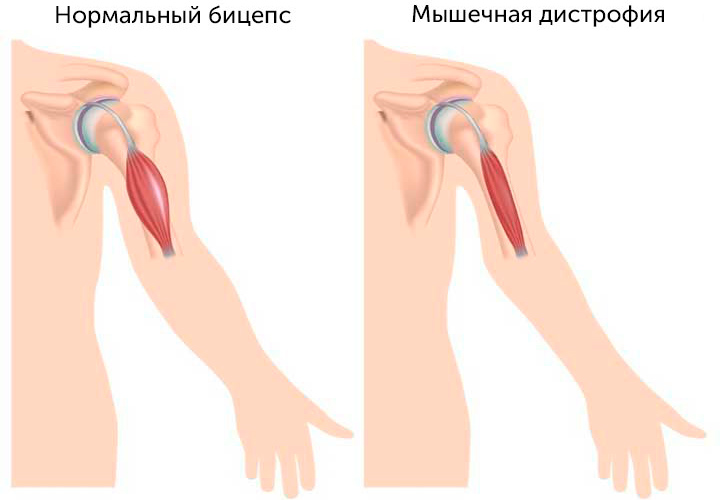 Мышечная дистрофия Мышечная дистрофия