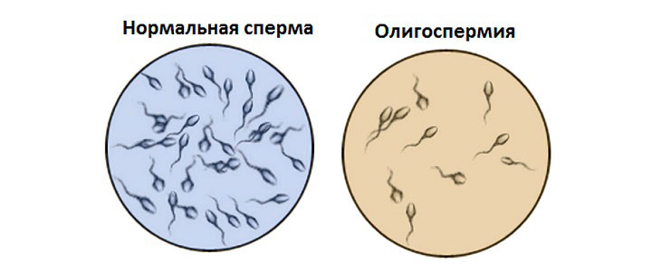 Олигоспермия – это снижение количества семенной жидкости Олигоспермия – это снижение количества семенной жидкости
