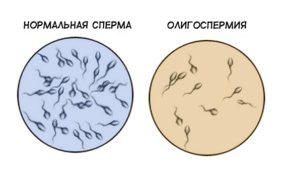 Что такое олигоспермия Что такое олигоспермия