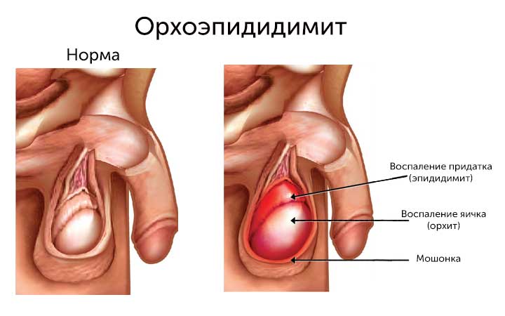 Орхит у мужчин Орхит у мужчин