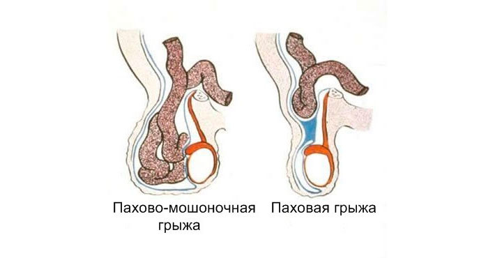 Пахово-мошоночная грыжа Пахово-мошоночная грыжа