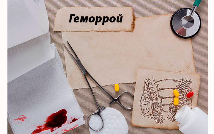 Первые признаки геморроя у мужчин Первые признаки геморроя у мужчин