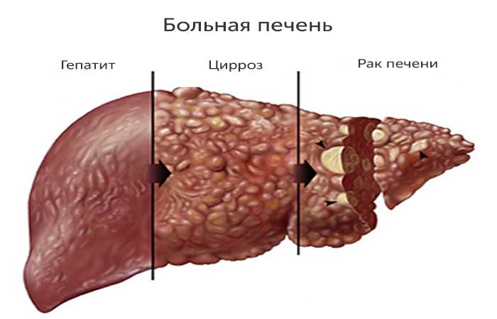 Пораженная печень Пораженная печень