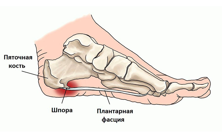 Шпора на пятке Шпора на пятке