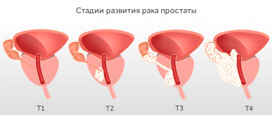 Стадии развития рака предстательной железы Стадии развития рака предстательной железы