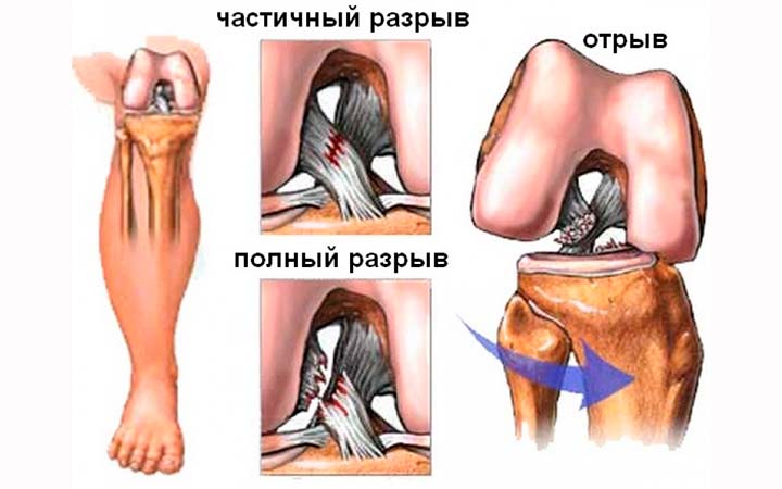 Разрывы мышечной ткани Разрывы мышечной ткани