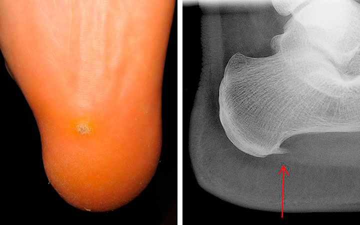 Рентген пяточной шпоры Рентген пяточной шпоры
