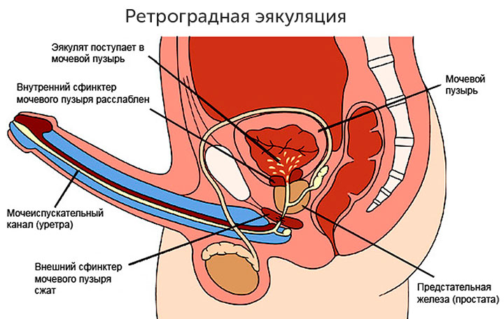Ретроградная эякуляция Ретроградная эякуляция