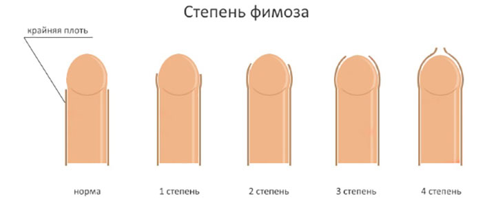 Степени фимоза Степени фимоза