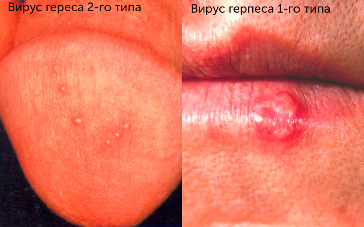Типы герпеса Типы герпеса