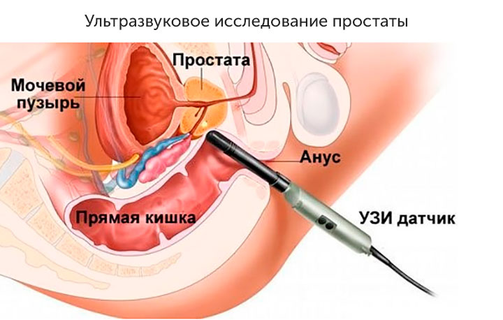 Ультразвуковое исследование простаты Ультразвуковое исследование простаты