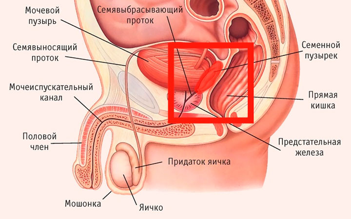 Везикулит у мужчин Везикулит у мужчин