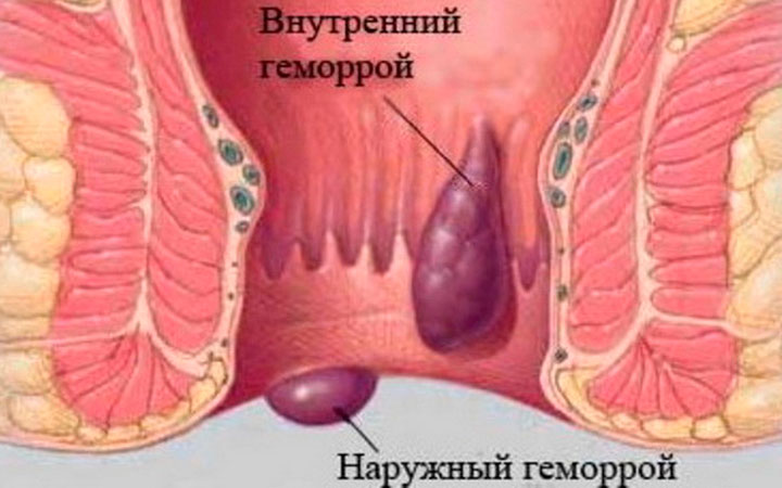 Внутренний и наружный геморрой Внутренний и наружный геморрой