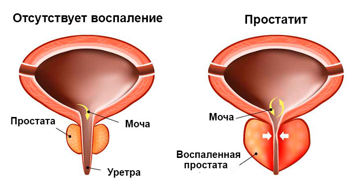 Воспаленная простата Воспаленная простата