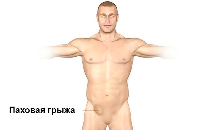 Выпячивание внутренних органов доставляет массу беспокойства Выпячивание внутренних органов доставляет массу беспокойства