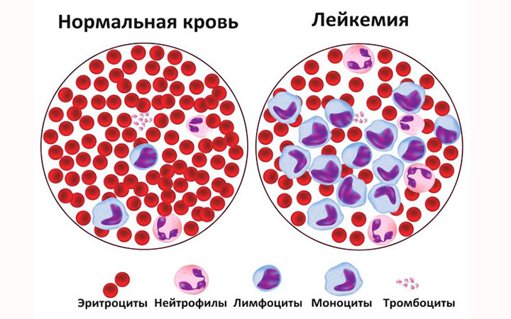 Заболевания крови могут носить и онкологический характер Заболевания крови могут носить и онкологический характер