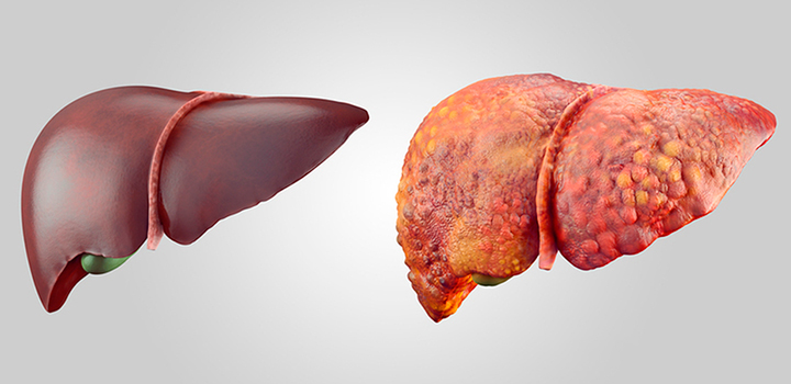 Здоровая и поврежденная печень Здоровая и поврежденная печень