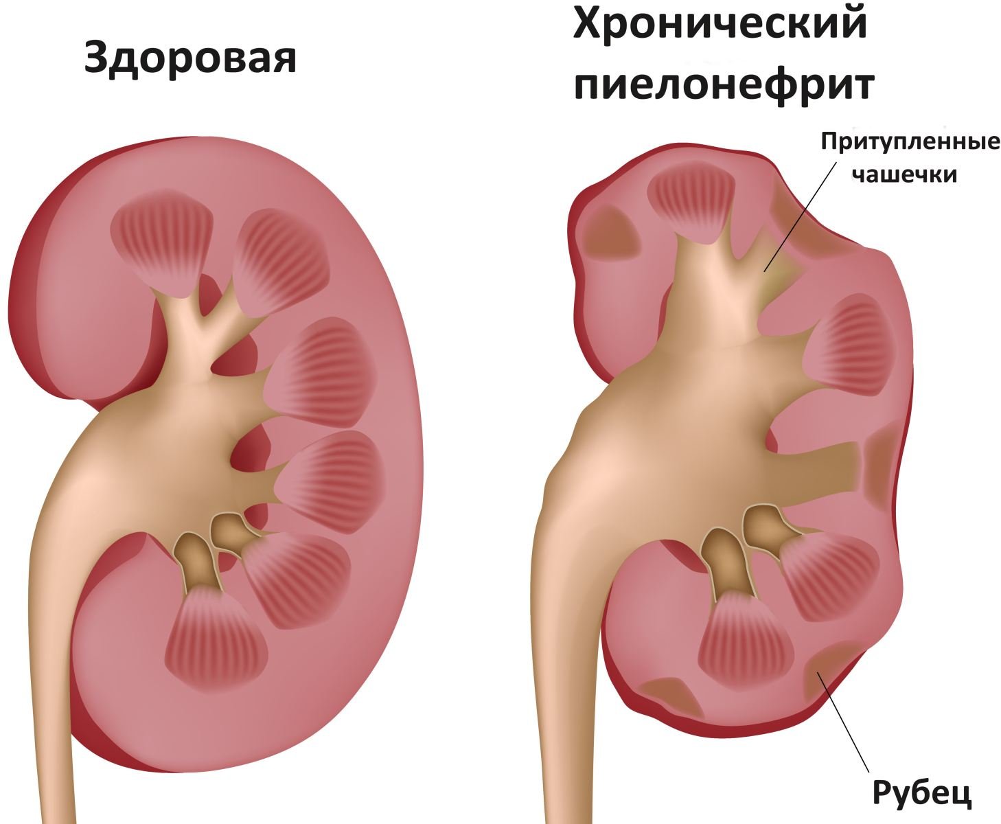 Пиелонефрит почек Хронический пиелонефрит
